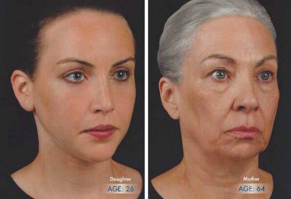 Mother-daughter comparison showing natural progression of face during the aging process. Mother-daughter comparison showing natural progression of face during the aging process.