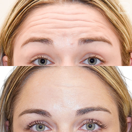 Botox Forehead Treatment Botox Forehead Treatment