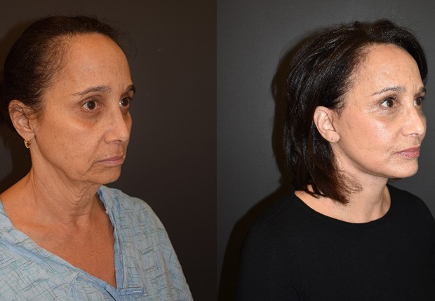 Before & after image showing the reduction in facial sagging and improved overall shape as a result of a facelift by Dr. Cross Before & after image showing the reduction in facial sagging and improved overall shape as a result of a facelift by Dr. Cross.