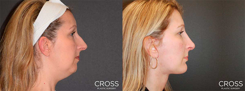 View before & after results from Cross Medical Group in Philadelphia, PA View before & after results from Cross Medical Group in Philadelphia, PA