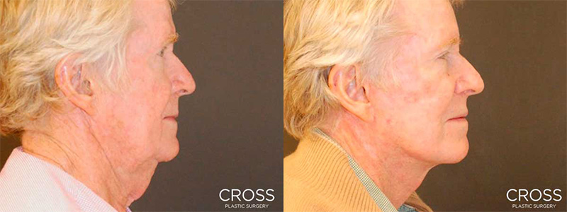 Improve neck elasticity with neck lift surgery. Improve neck elasticity with neck lift surgery.