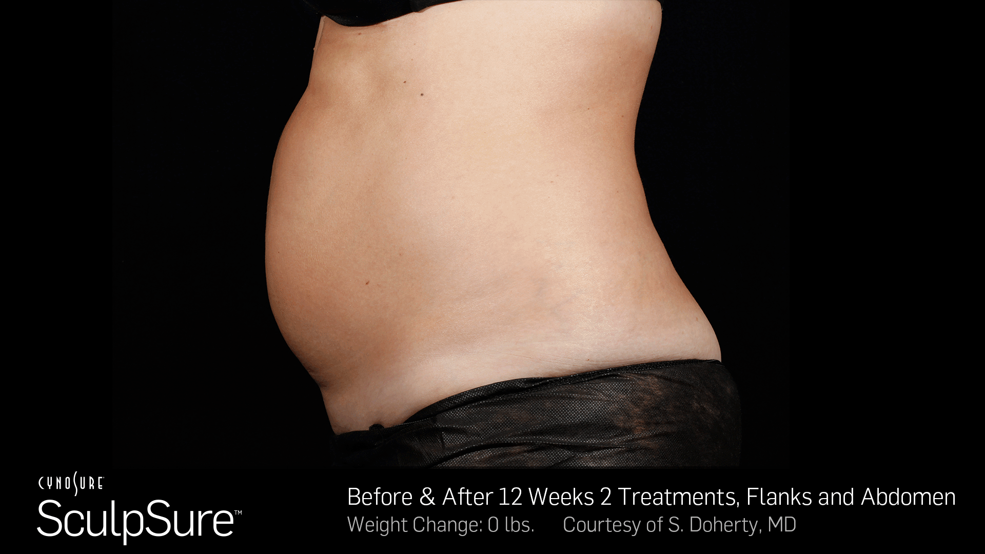 SculpSure before & after results post 12 weeks with a single treatment. SculpSure before & after results post 12 weeks with a single treatment.