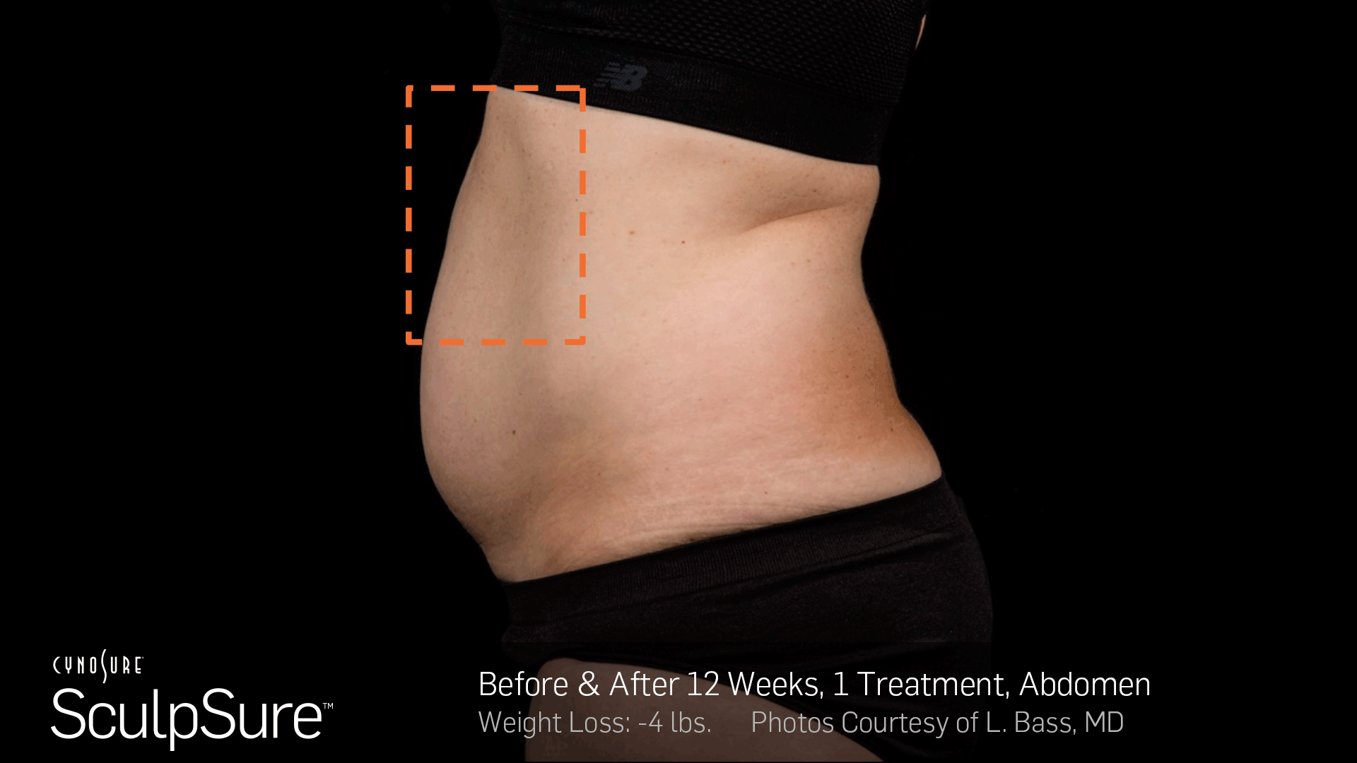 SculpSure before & after results post 12 weeks with a single treatment. SculpSure before & after results post 12 weeks with a single treatment.