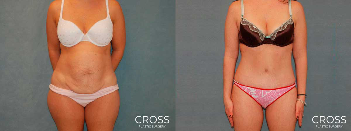 View before & after results from Cross Medical Group in Philadelphia, PA View before & after results from Cross Medical Group in Philadelphia, PA